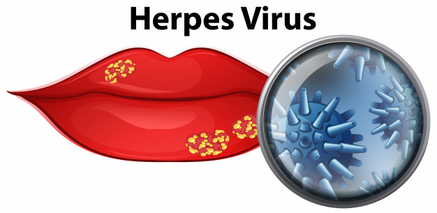 Papilloma virus herpes labiale, Hpv e herpes labiale, Leziunea herpetica - Herpesul